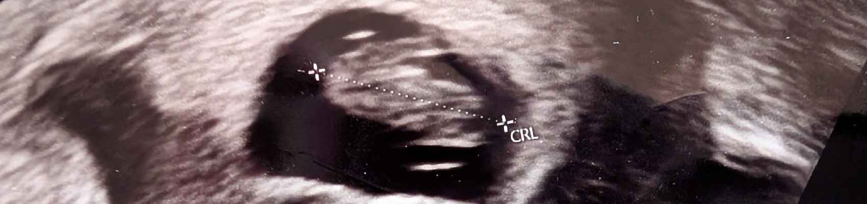 Early ultrasound view